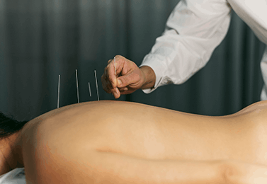 Dry Needling 1
