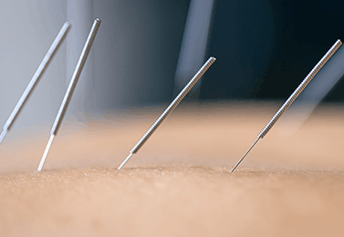 Dry Needling 2