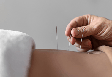 Dry Needling 3