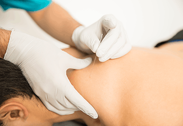 Dry Needling 4
